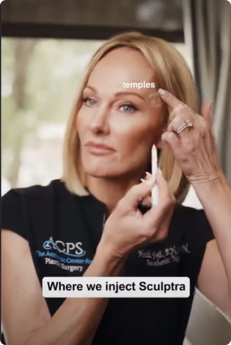 Where we inject Sculptra