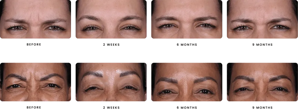 DAXXIFY™ before and after images