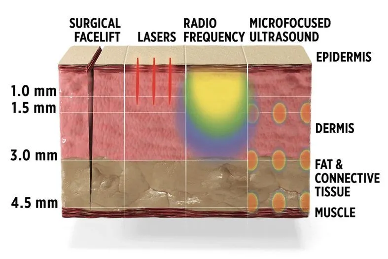 Donde actúa ultherapy en la piel