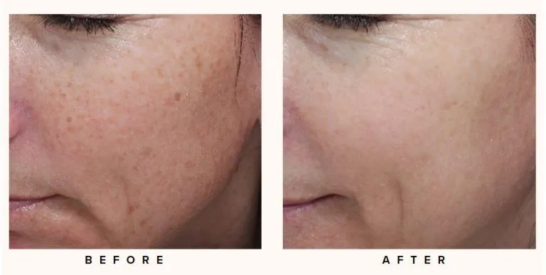 Before and after moxi laser