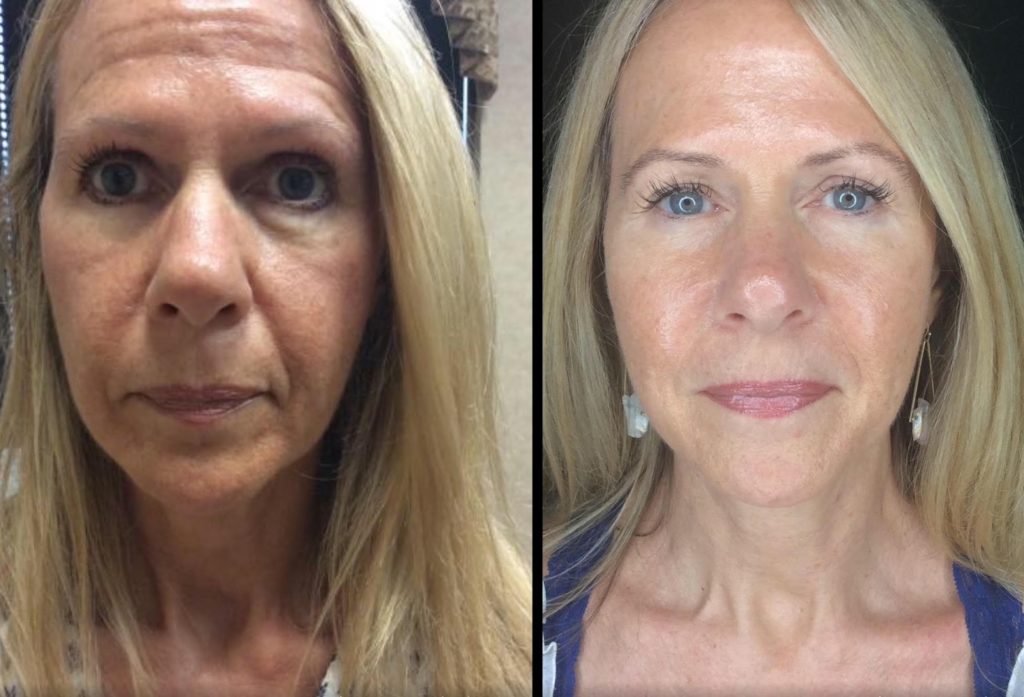 Shawna_liquid facelift