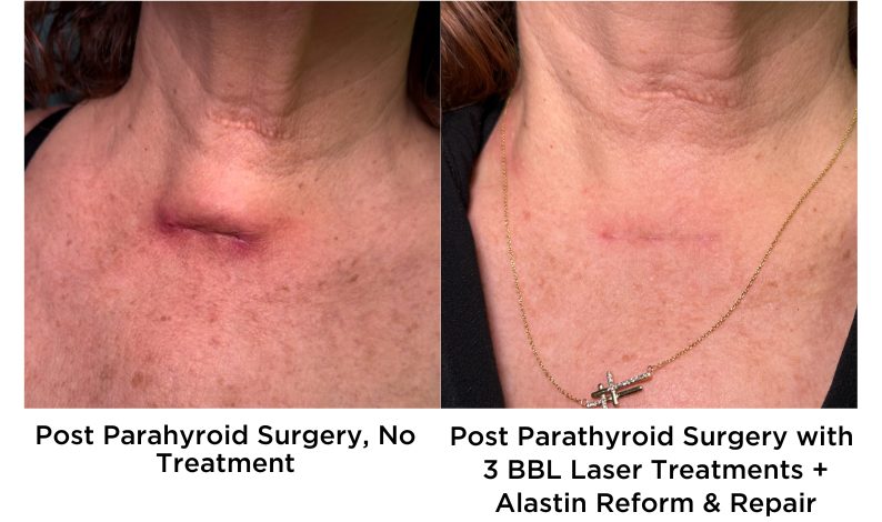 Post Parahyroid Surgery, No Treatment and Post Parathyroid Surgery with 3 BBL Laser Treatments + Alastin Reform & Repair