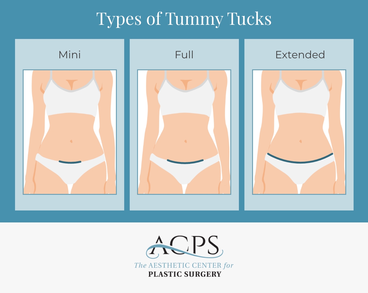 Infographic comparing three types of tummy tucks with illustrated female torsos labeled mini, full, and extended.
