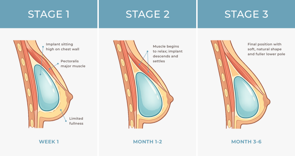 Infographic illustrating the stages of breast implant after breast augmentation.