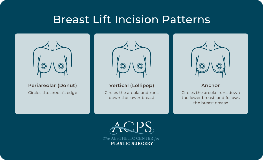 Diagrams of periareolar, vertical, and anchor breast lift incisions showing each scar path