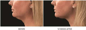 COOLSCULPTING BEFORE & AFTER DOUBLE CHIN TREATMENT