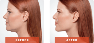 kybella_before-after1