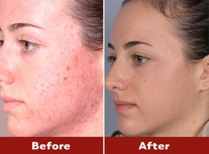 silkpeel-before-and-after