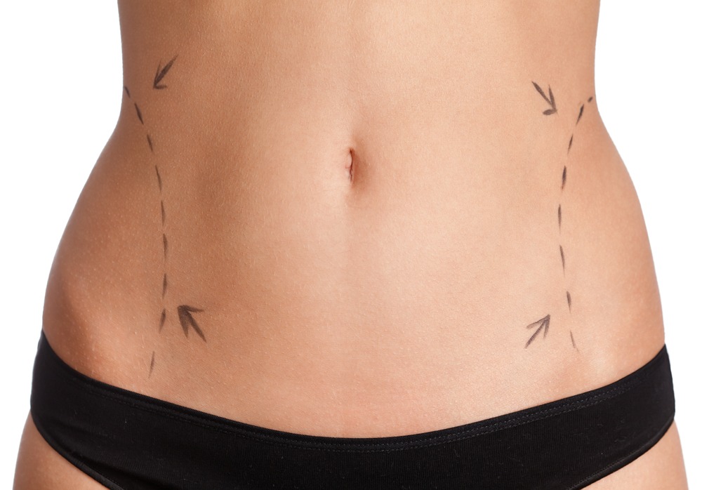 Tummy Tuck Surgery (Abdominoplasty) vs. Laser Liposuction