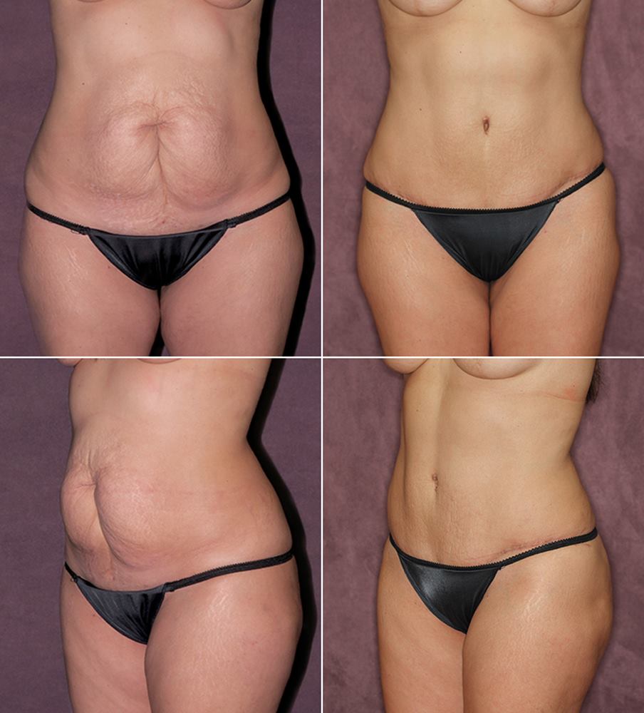 These before and after photos of Dr. Patronella's tummy tuck patient demonstrate the details he incorporates to create more authentic-looking rummy tuck results. This includes subtle contouring and a smooth, even skin tone that seamlessly blends with adjacent areas.