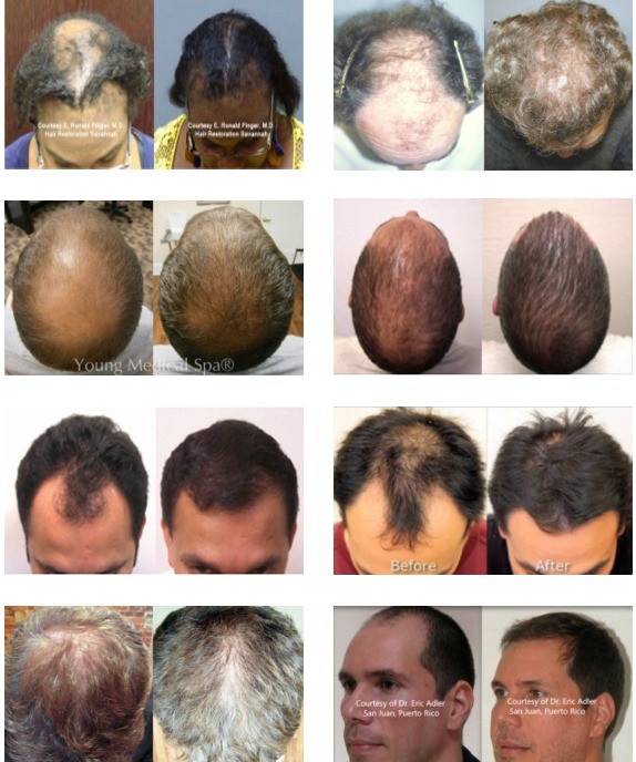 NeoGraft Hair Restoration Before & After Photos