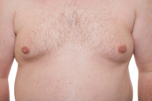 Gynecomastia (Male Breast Reduction) Surgery Procedure Steps | Houston